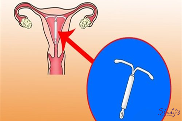 Đặt vòng là cách tránh thai hiệu quả được nhiều chị em sử dụng