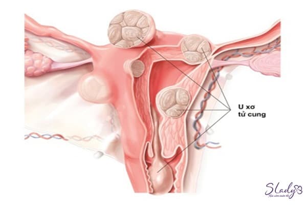 U xơ tử cung là những khối u nhỏ hình thành và phát triển từ lớp cơ của tử cung