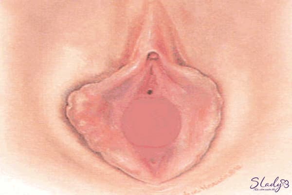 Màng trinh bị bịt kín