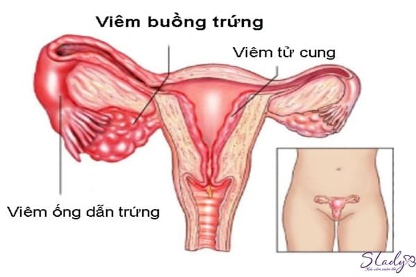 Nguyên nhân gây vô sinh ở nữ giới có thể xuất phát từ buồng trứng, tử cung
