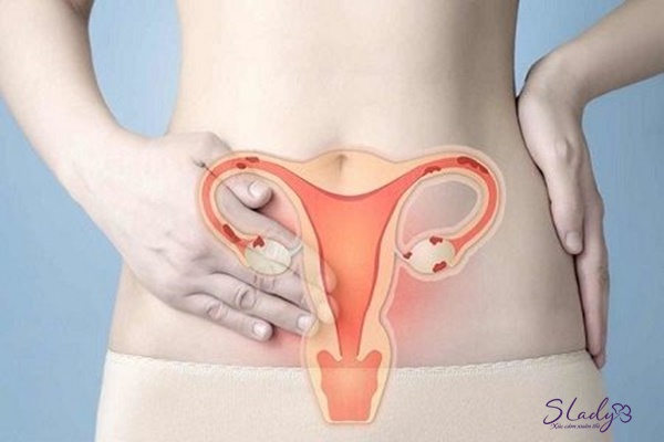 3 Nhóm đối tượng dễ nhiễm trùng tử cung sau khi sinh nhất