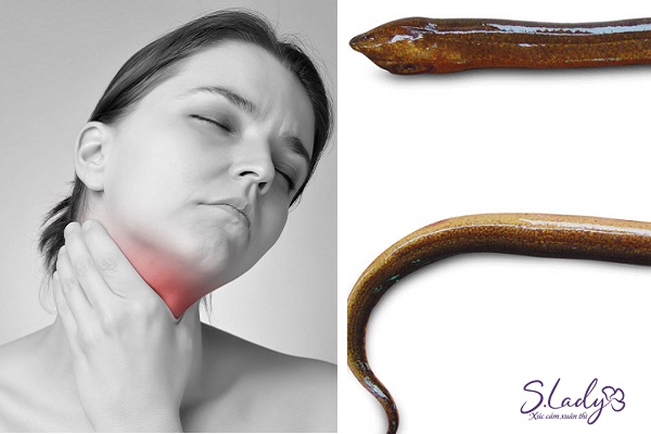Hậu sản đuôi lươn có triệu chứng vướng cổ như đuôi con lươn bị mắt bên trong