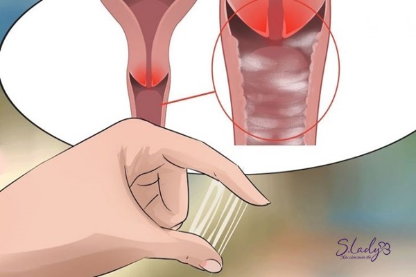 Ra dịch bất thường là một trong những triệu chứng viêm nội mạc tử cung sau khi sinh